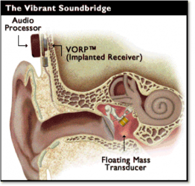 Tekening van implantaat in het oor